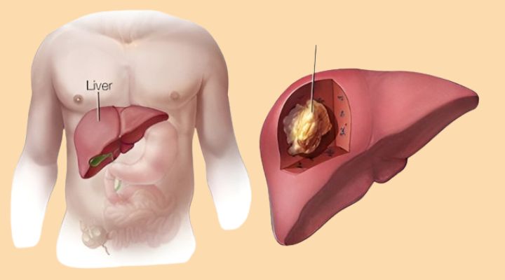 Recognizing the Red Flags: 10 Warning Signs of Liver Damage You Shouldn’t Ignore