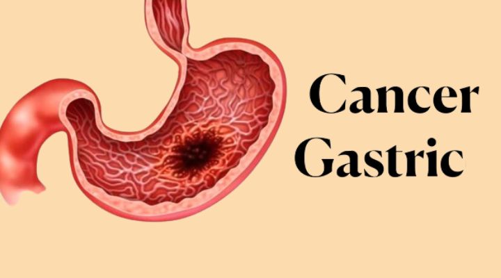 Exposing the Quiet Danger: Indices and Manifestations of Gastric Cancer