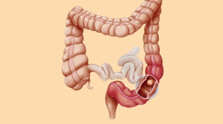 Unusual Signs of Colon Cancer: Recognizing Symptoms Often Overlooked